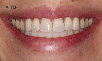 invisalign-1-after