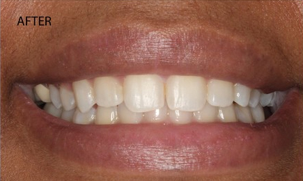 invisalign-2-after