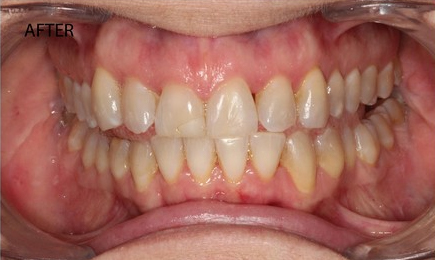 invisalign-3-after